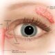 Dry Eye Symptoms