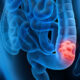 colon cancer symptoms colon cancer symptoms in women colon cancer in women symptoms colon cancer mortality rate colon cancer survival rate what does colon cancer look like can colon cancer be cured will colon cancer cause back pain what bowel cancer symptoms why colon cancer is on the rise test for colon cancer poop with colon cancer is colon cancer hereditary test for colon cancer without colonoscopy pain with colon cancer colon cancer vs ibs colon cancer versus hemorrhoids colon cancer vs colorectal cancer colon cancer and diverticulitis colon cancer and anemia