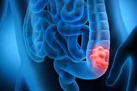 colon cancer symptoms colon cancer symptoms in women colon cancer in women symptoms colon cancer mortality rate colon cancer survival rate what does colon cancer look like can colon cancer be cured will colon cancer cause back pain what bowel cancer symptoms why colon cancer is on the rise test for colon cancer poop with colon cancer is colon cancer hereditary test for colon cancer without colonoscopy pain with colon cancer colon cancer vs ibs colon cancer versus hemorrhoids colon cancer vs colorectal cancer colon cancer and diverticulitis colon cancer and anemia
