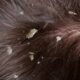 How to get rid of lice, How to get rid of lice permanently, How to get rid of quickly, How to get rid of in hair, How to get rid of naturally, How to get rid of overnight
